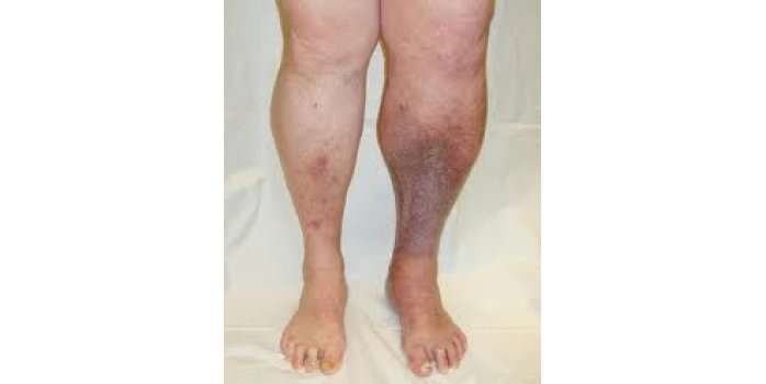 Peripheral Venous Vein Disease APM