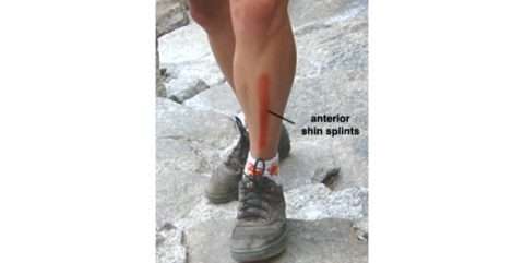 Shin Splints | APM